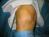 Leefregels na een operatie van een verwijde buikslagader via de liezen (E.V.A.R) (Endovasculair Aneurysma Repair)