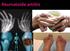 Reuma is een verzamelnaam voor meer dan 100 verschillende aandoeningen Ontstekingsreuma Ontstekingen aan de gewrichten Artrose Gewrichtsslijtage