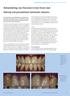 Behandeling van fluorose in het front met. behulp van porseleinen laminate veneers. restauratieve tandheelkunde - door Marco Gresnigt, tandarts* Casus