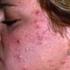 HIDRADENITIS SUPPURATIVA (ACNE INVERSA, ACNE ECTOPICA) WAT BETEKENT HIDRADENITIS SUPPURATIVA?