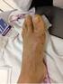 Hallux valgus chirurgie