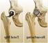 De totale heupprothese en heup-resurfacing