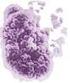 Mastocytose. een ziekte door grote hoeveelheden abnormale mestcellen