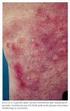 Huidaandoeningen/ huidafwijkingen. Algemene pathologie. Efflorescenties 14-1-2014. Oorzaken van pathologische processen
