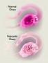 PCOS PolyCysteus Ovarium Syndroom