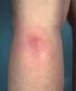 Dermatologie. Lyme-borreliose / Ziekte van Lyme