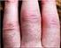 Reumatische Koorts en Post-Streptokokken Reactieve Artritis