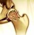Botbreuk en botontkalking (osteoporose)