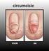 Operatief opheffen van vernauwde voorhuid/ besnijdenis bij jongens. Besnijdenis (circumcisie) onder narcose