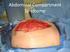 Abdominal Compartment Syndrome (ACS);