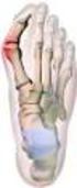 Vastzetten van het gewricht tussen het 1 e voetwortelbeentje en het 1 e middenvoetsbeentje (TMT-1 arthrodese)