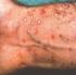 Wat is Lichen Planus?