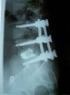 Spondylolytische spondylolisthesis