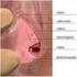 Inleiding Wat is endometriose