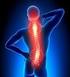 Beknelling van spieren/spiergroepen in het kapsel door zwelling. Chronisch compartiment syndroom aan het onderbeen