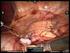 Pyelumplastiek Operatie om de vernauwing in de overgang van de nierbekken naar de urineleider op te heffen