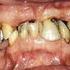 Behandeling van een sterk gemutileerde dentitie