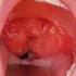 Verwijderen van de keelamandelen Tonsillectomie