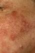 Dermatologie. Rosacea. Slingeland Ziekenhuis