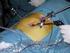 Liesbreuk : laparoscopische behandeling