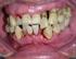Patiënteninformatie over: de behandeling van tandvleesontsteking. Meer dan 2 miljoen patiënten behandeld. Parodontaal herstel met Straumann Emdogain