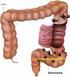 CT-scan van de dikke darm (CT-colon)