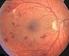 Behandeling van diabetische retinopathie en maculopathie: waar staan we? Dr. Goethals Sebastien Consulent UZ Leuven, oogziekten, medische retina
