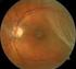 Vitrectomie bij netvliesloslating (ablatio retinae) gecombineerd met cataractextractie