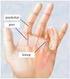 Haperende vinger (triggerfinger) Behandeling van een verdikking of knobbel van de peesschede van de vinger of duim door de plastische chirurg