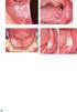 Premaligne slijmvliesafwijkingen in de mondholte