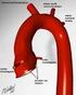 Thoracaal Aorta Aneurysma (met kans op) Dissectie (TAAD)