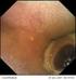 Videocapsule-endoscopie Onderzoek van de dunne darm met een videocapsule