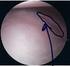 Etiology, diagnosis and arthroscopic treatment of the anterior ankle impingement syndrome Tol, J.L.