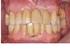 Het verkorte-tandboogconcept: een behandelingsstrategie bij uitgebreide gebitsmutilaties