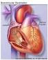 Implantatie Biventriculaire Pacemaker