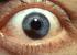 Oogmelanoom Behandeling van het oog