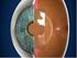 Hoe gaat het met de corneale refractie chirurgie? Annette Geerards, Oogziekenhuis Rotterdam