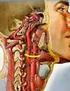 Symptomatische stenose van de arteria carotis: endarteriëctomie veiliger dan stenten