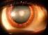 Cataract Operatie en nazorg