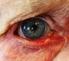 Wat is een achterste glasvochtmembraan loslating van het oog?