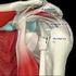 Schouder: Rotator cuff ruptuur