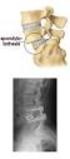 Lumbale spondylodese. Wervelkolom. Orthopedie