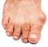 Hallux Valgus + Bunion