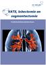 VATS, lobectomie en segmentectomie. Ondertitel Patiënteninformatiebrochure.